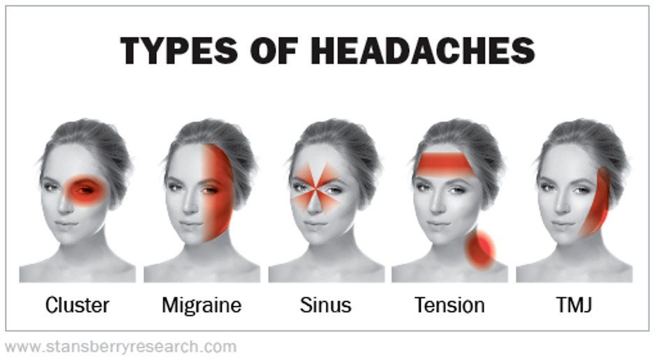 Tipovi glavobolje s obzirom na mjesto boli | Author: Pinterest