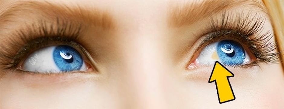 Zdravstveni simptomi vidljivi na očima | Author: brightside.me