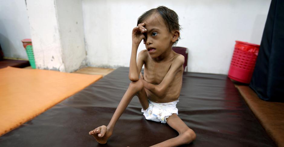 Pothranjeno dijete u Jemenu | Author: ABDULJABBAR ZEYAD/REUTERS/PIXSELL