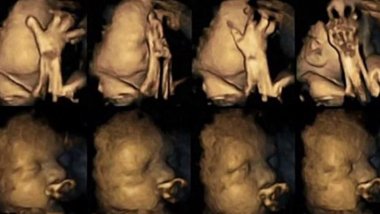 Snimka ultrazvuka fetusa pušačice